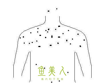 背上長(zhǎng)痘痘該怎樣處理